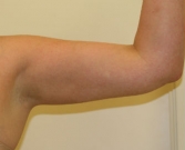 Feel Beautiful - Liposuction left arm - After Photo